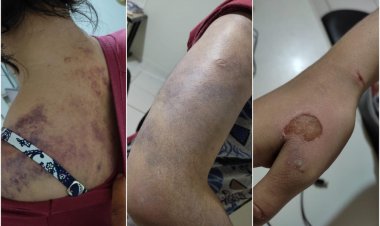 Mecânico é preso suspeito de espancar a mulher por 6 horas e colocar fogo na mão dela, em Posse